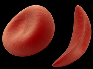 sickle-cell-disease
