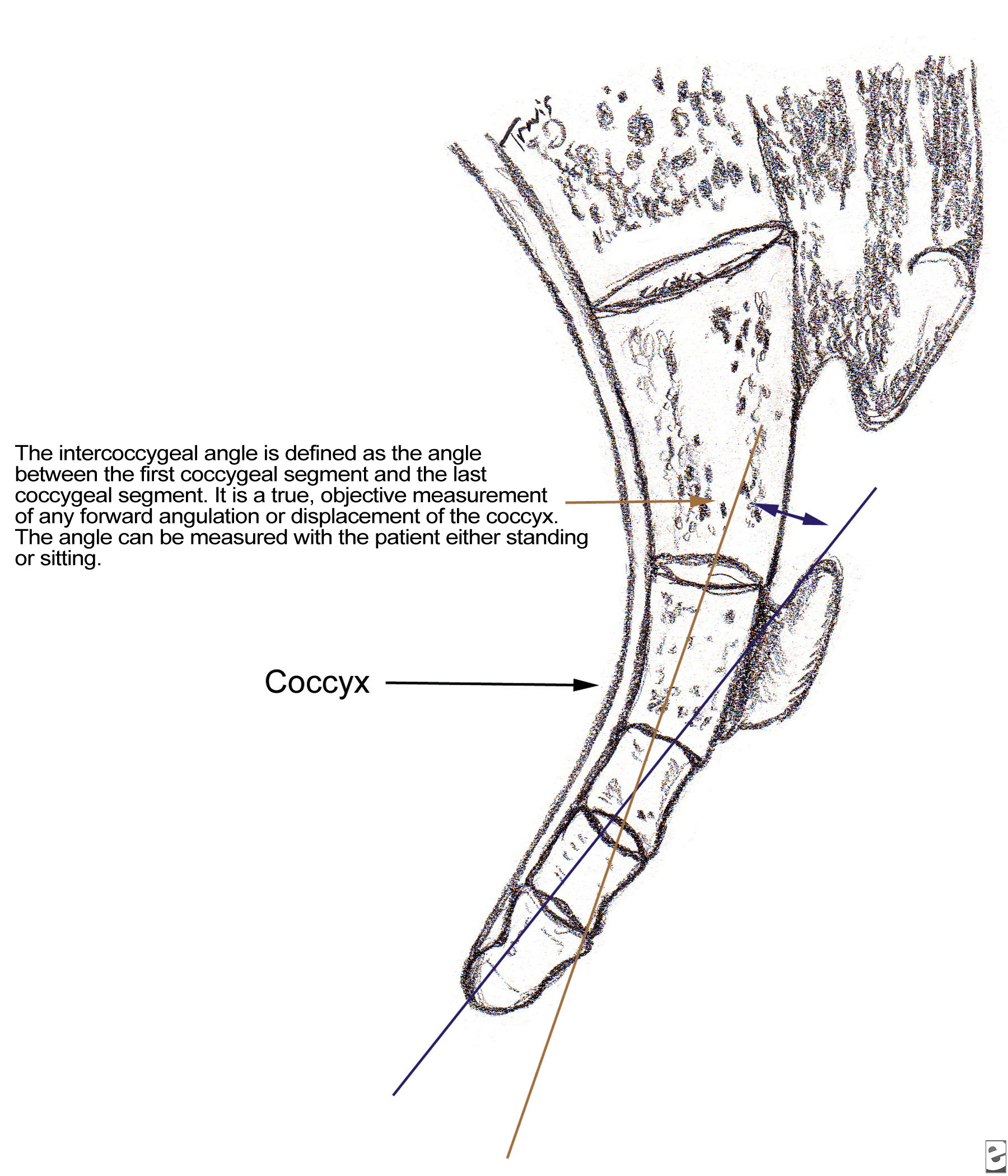 coccyx fracture