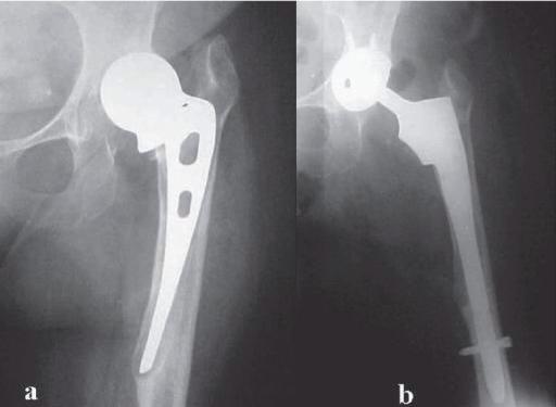 History of Total Hip Prosthesis 