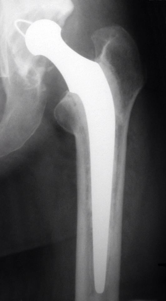 History of Total Hip Prosthesis 