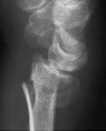 Colles' Fracture