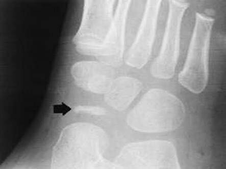 Kohler's disease 