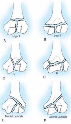 Mehne and Matta Classification for Intercodylar Fractures of Humerus