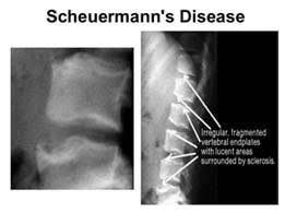 Scheuermann's Disease